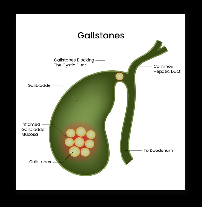 Gallstones