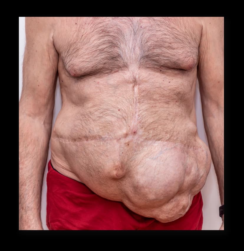 Incisional Hernia