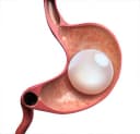 Gastritis Balloon